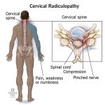 22639-cervical-radiculopathy.jpg