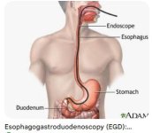 esophagogastroduodenoscopy.JPG